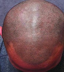 Scalp Micro pigmentation for Men