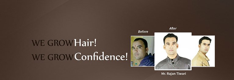 hair transplant in Chennai