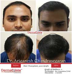 hair transplant before after chennai