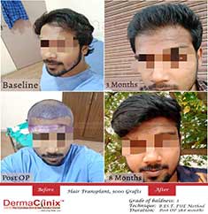 best hair transplant in chennai results