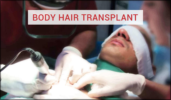 Body Hair Transplant