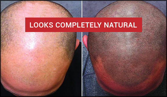 Scalp micropigmentation treatment in Chennai