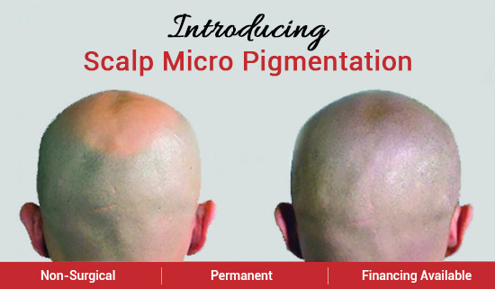 Scalp micropigmentation treatment in Chennai