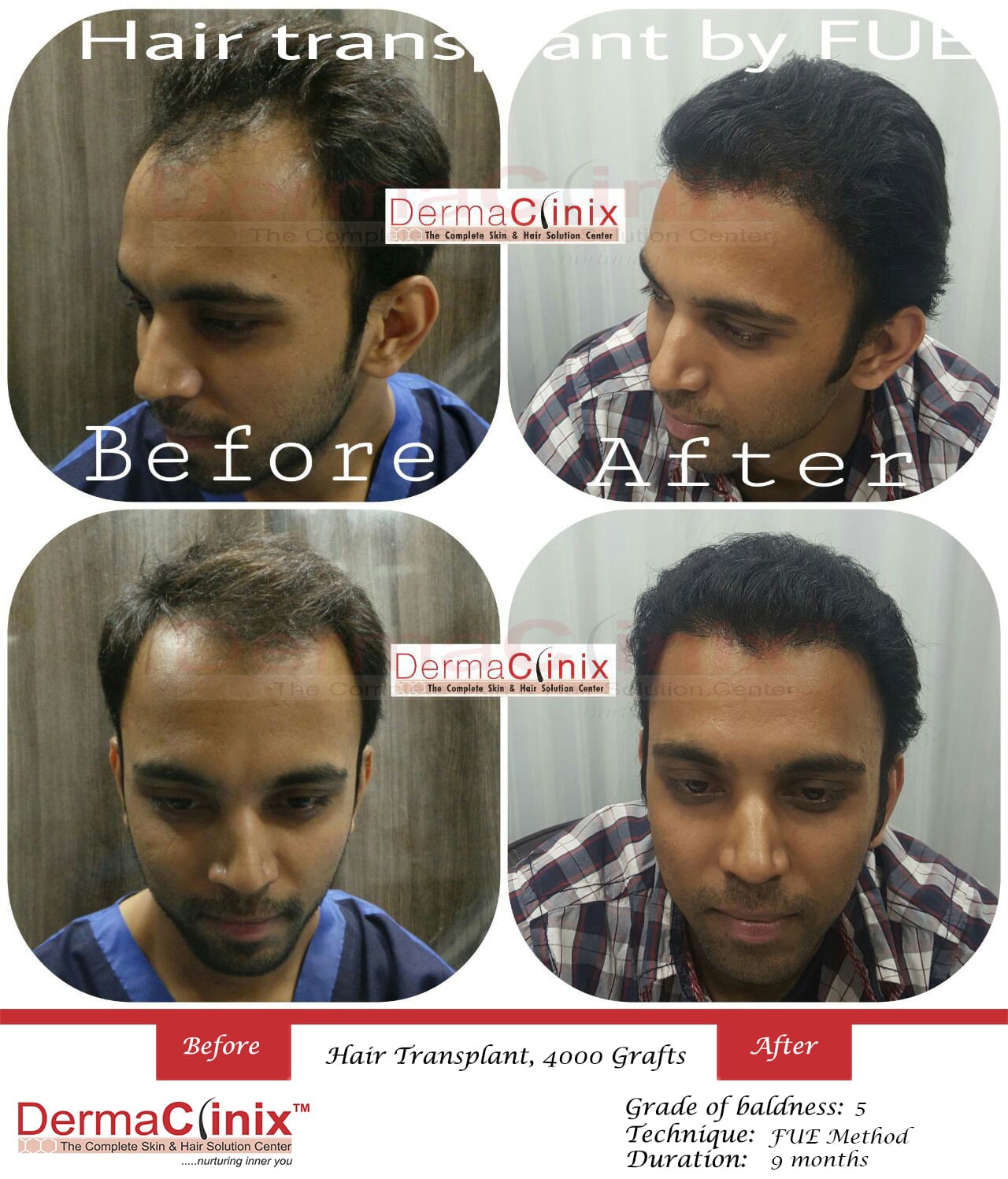 Hair Transplant Results in Chennai, Before After Photos DermaClinix