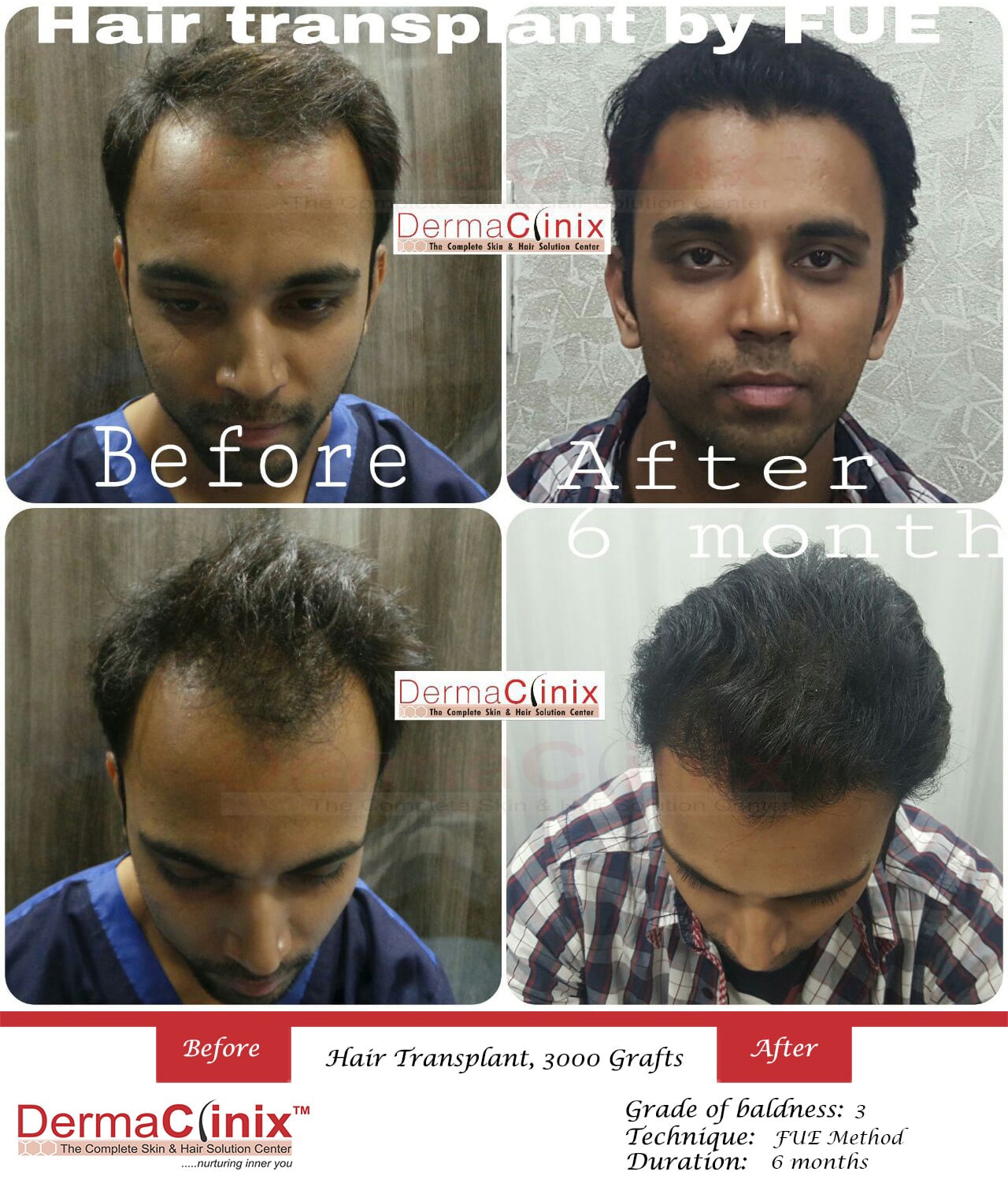 Hair Transplant Results in Chennai, Before After Photos - DermaClinix Hair Transplant Results in Chennai, Before After Photos - DermaClinix