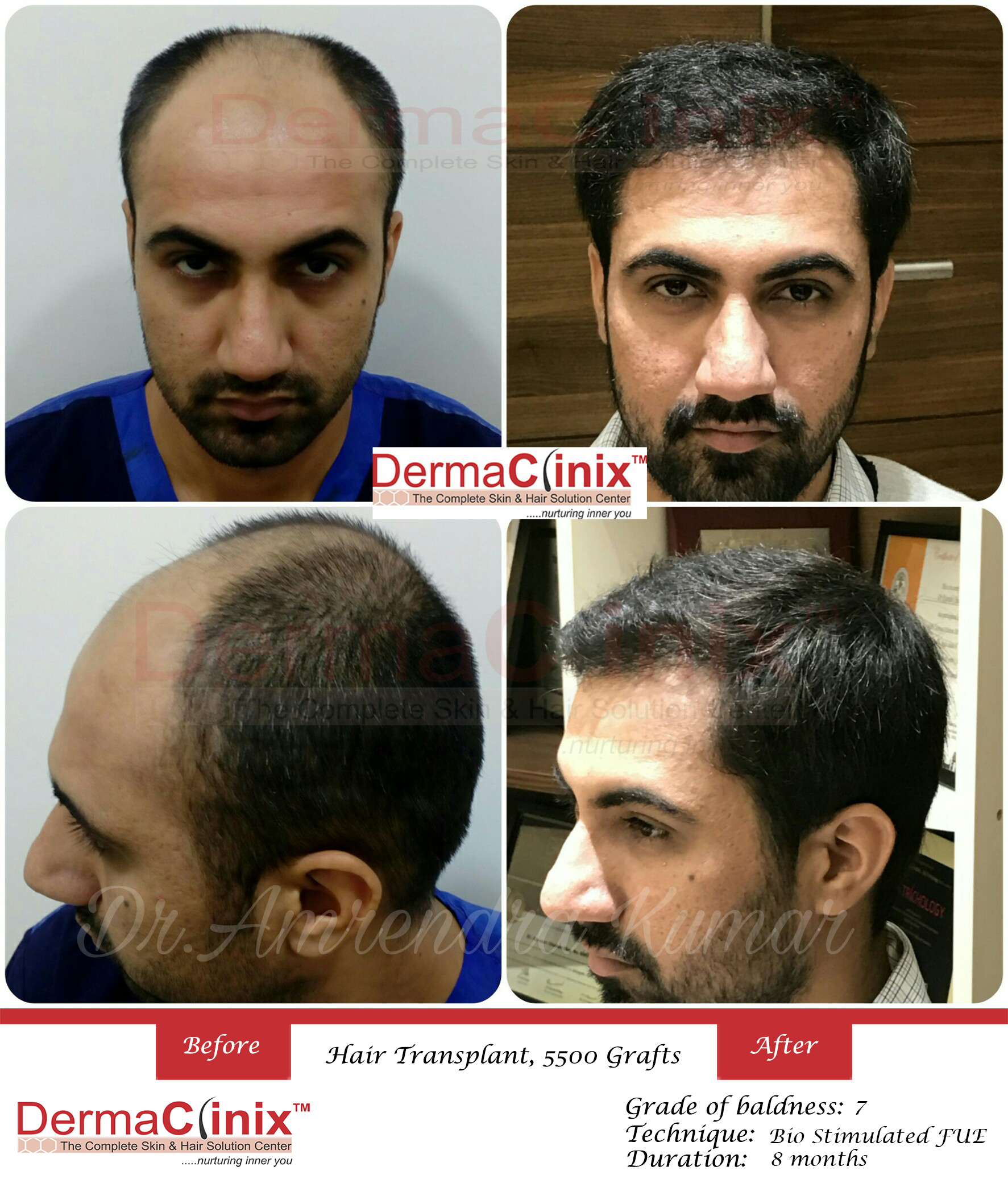 Hair Transplant Results in Chennai, Before After Photos - DermaClinix Hair Transplant Results in Chennai, Before After Photos - DermaClinix