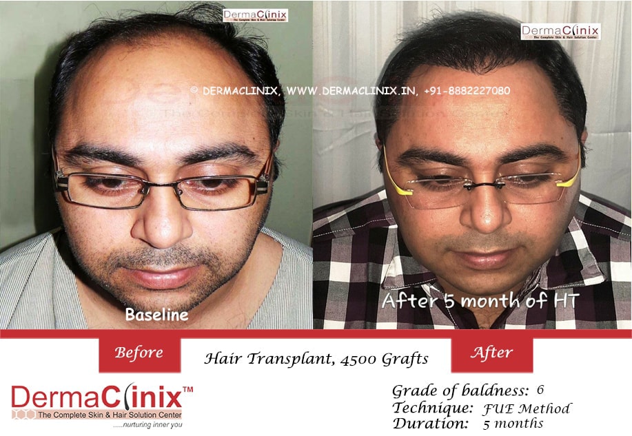 Hair Transplant Results in Chennai, Before After Photos - DermaClinix