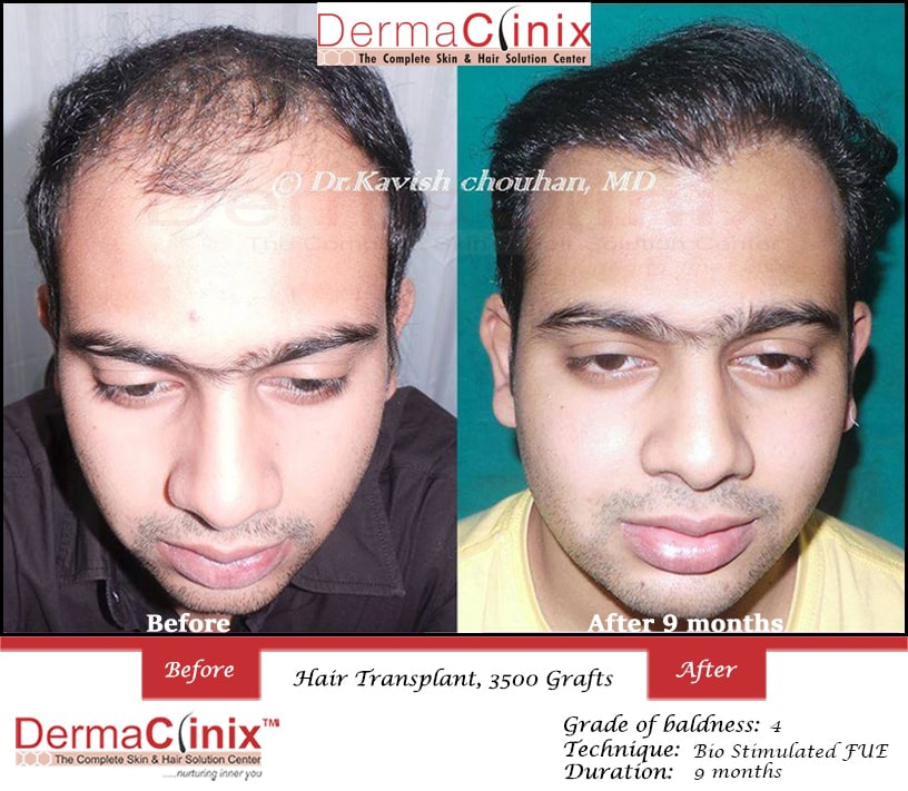 Hair Transplant Results in Chennai, Before After Photos - DermaClinix Hair Transplant Results in Chennai, Before After Photos - DermaClinix