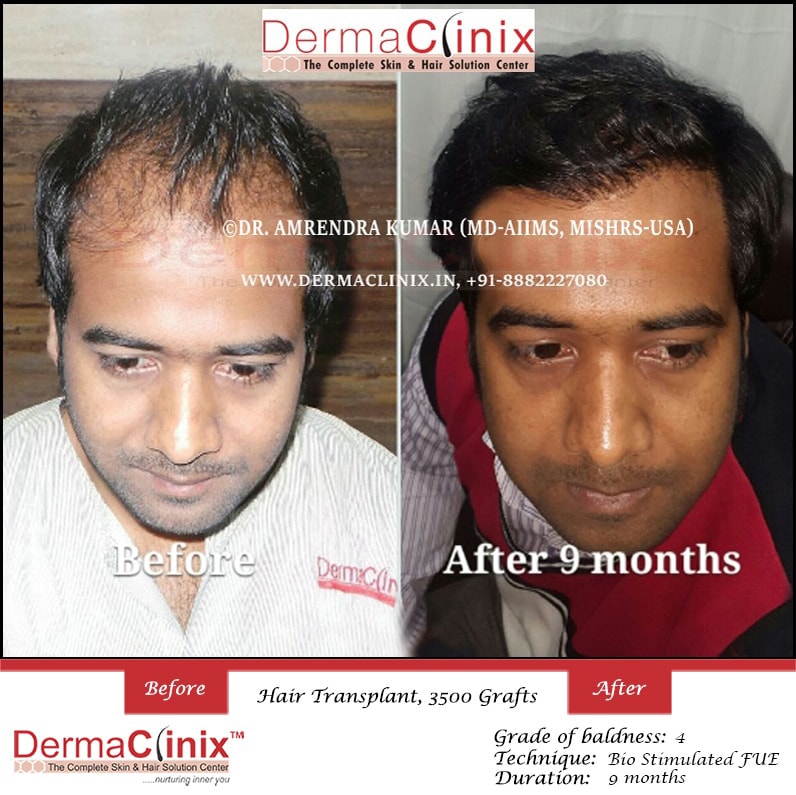 Hair Transplant Results in Chennai, Before After Photos - DermaClinix Hair Transplant Results in Chennai, Before After Photos - DermaClinix