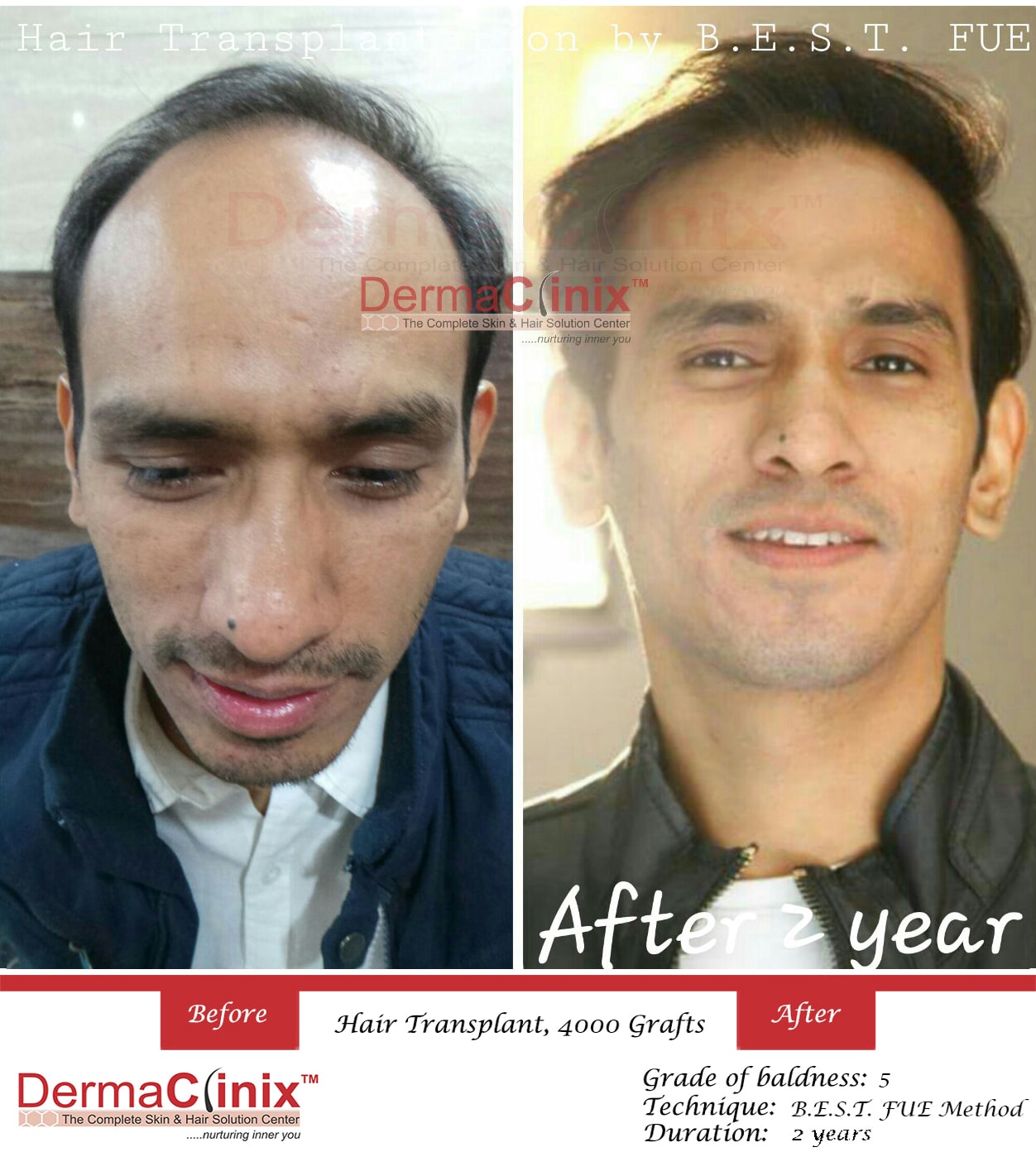 Hair Transplant Results in Chennai, Before After Photos - DermaClinix Hair Transplant Results in Chennai, Before After Photos - DermaClinix