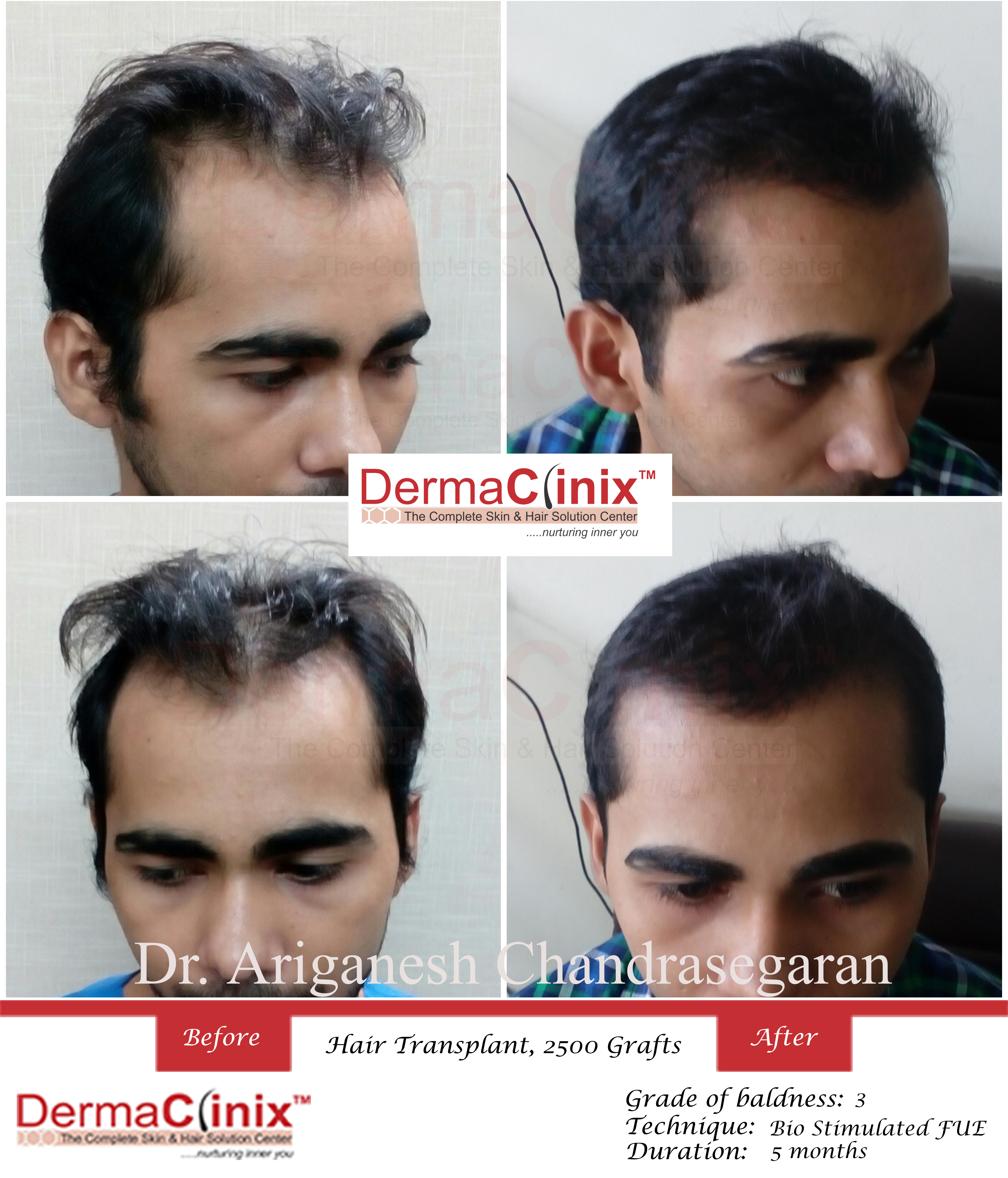 Hair Transplant Results in Chennai, Before After Photos - DermaClinix Hair Transplant Results in Chennai, Before After Photos - DermaClinix