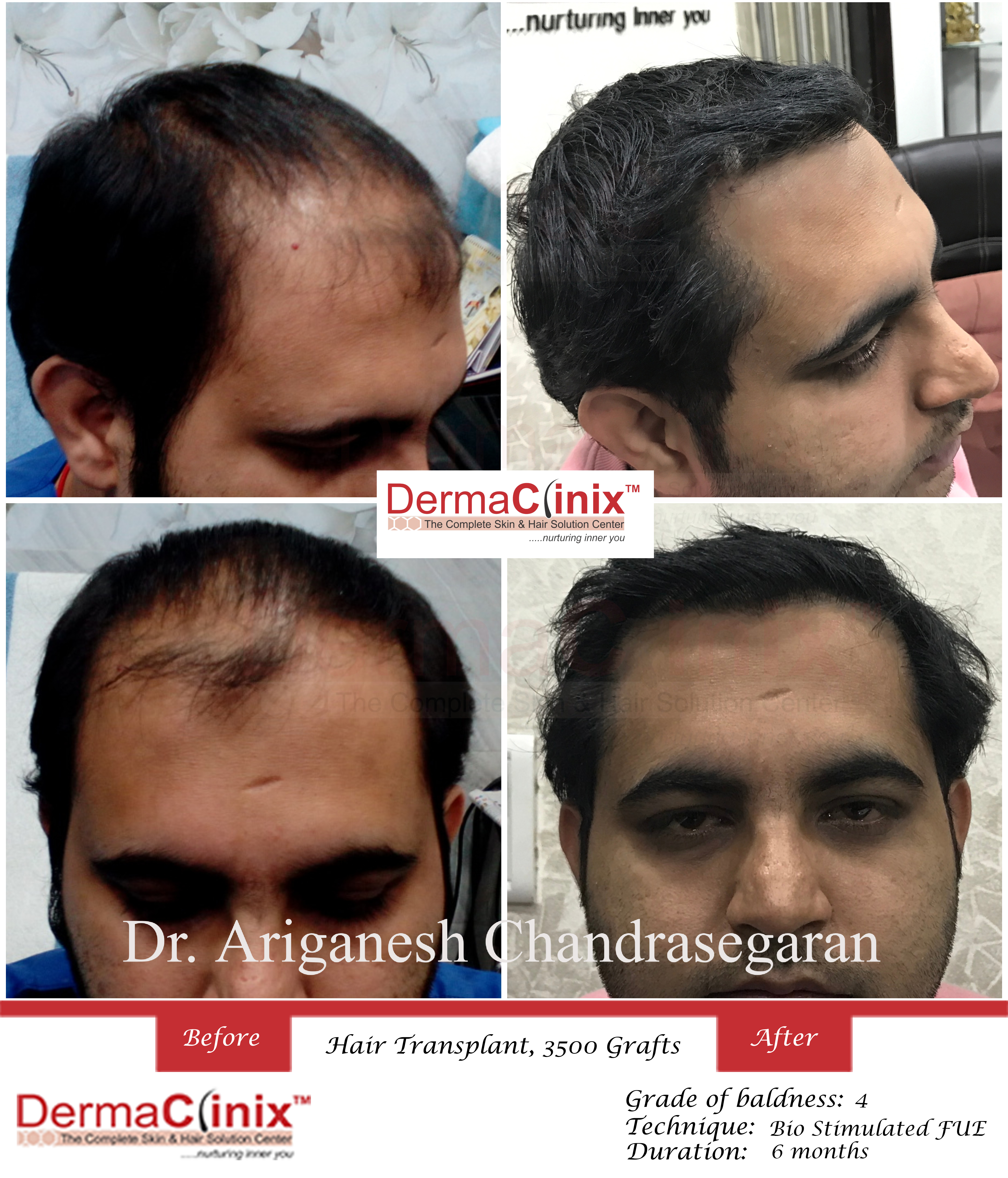 Hair Transplant Results in Chennai, Before After Photos - DermaClinix