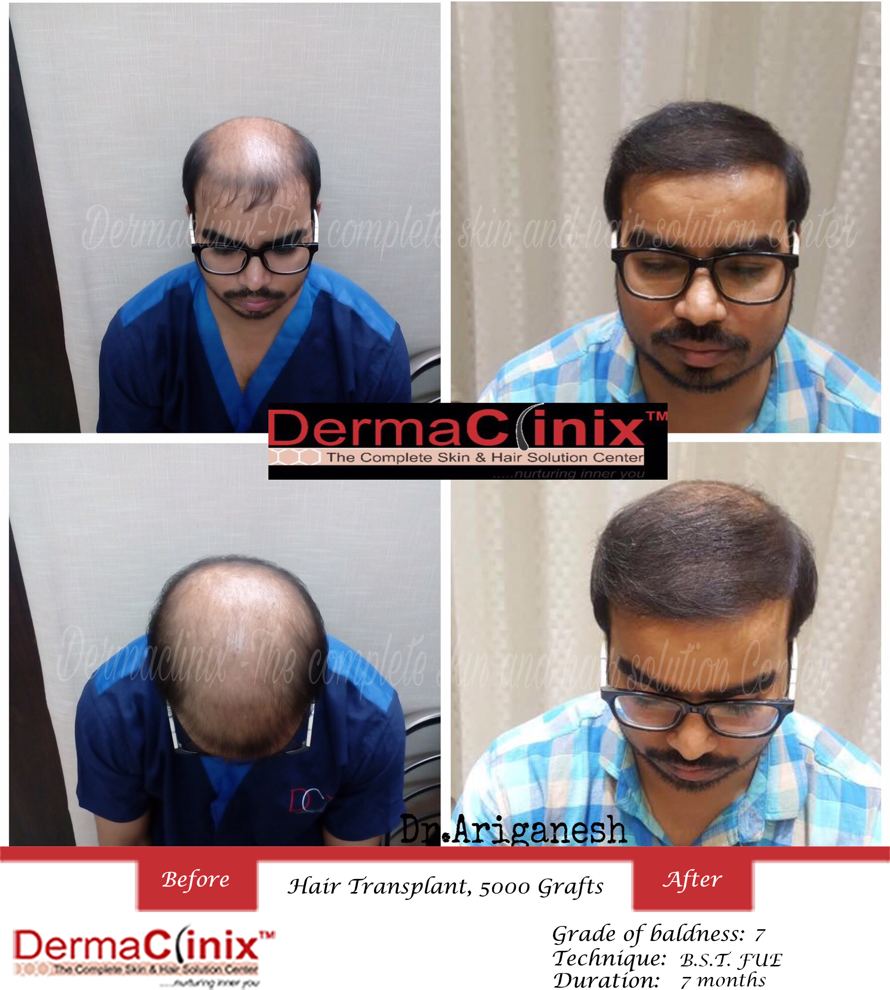 Hair Transplant Results in Chennai, Before After Photos - DermaClinix Hair Transplant Results in Chennai, Before After Photos - DermaClinix