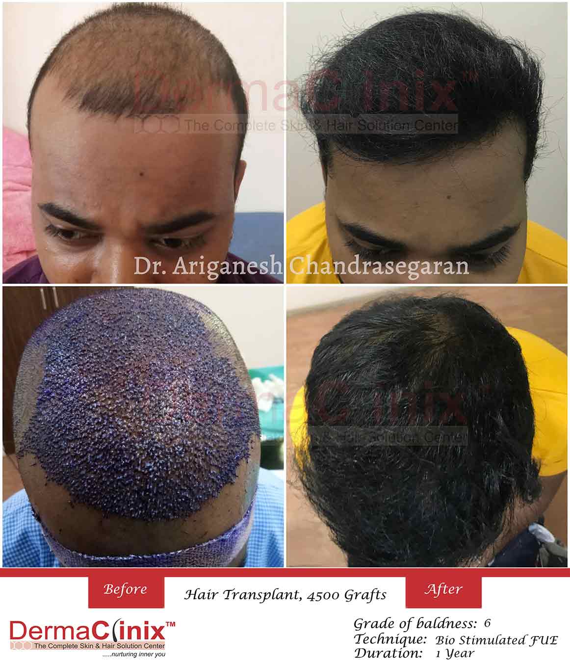 How Much Time Does It Take For Hair To Develop After Hair Transplant? - Hair  Sure