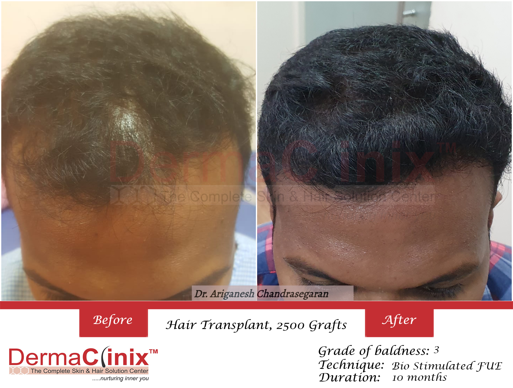 Hair Transplant Results in Chennai, Before After Photos - DermaClinix Hair Transplant Results in Chennai, Before After Photos - DermaClinix
