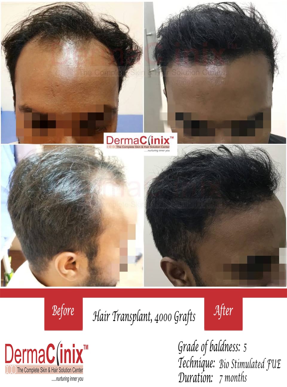 Hair Transplant Results in Chennai, Before After Photos - DermaClinix Hair Transplant Results in Chennai, Before After Photos - DermaClinix