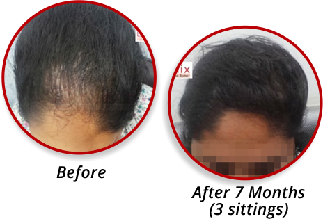 PRP Treatment in Chennai | PRP Therapy Cost in Chennai for Hair Fall - DermaClinix PRP Treatment in Chennai | PRP Therapy Cost in Chennai for Hair Fall - DermaClinix